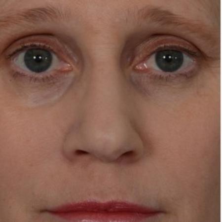 Before image 1 Case #86321 - 50 year old woman treated with nonsurgical rhinoplasty