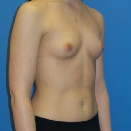 Before image 2 Case #86651 - Submuscular Breast Augmentation 390cc Shaped - Medium Height - High Profile Silicone Gel Implants