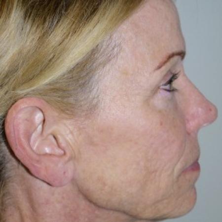Before image 3 Case #82441 - 56 year old with facial wrinkles, history of acne scarring