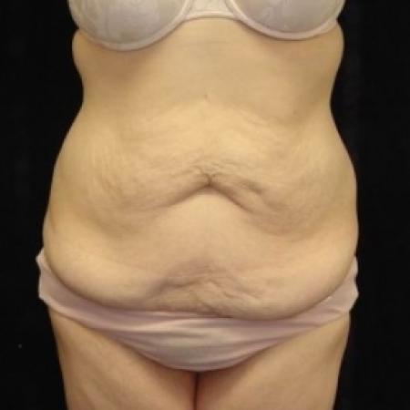 Before image 1 Case #80226 - Circumfrential Abdominoplasty with Liposuction of Abdomen, Waist, and Flanks