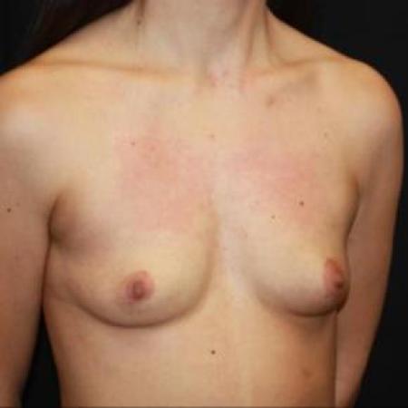 Before image 2 Case #85841 - Breast Augmentation - 32 year old female