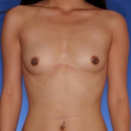 Before image 1 Case #79931 - Breast augmentation silicone