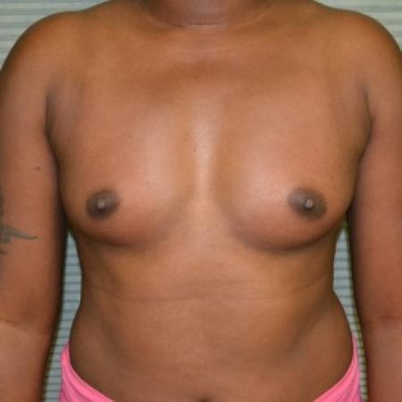 Before image 1 Case #87811 - Breast Augmentation with Mentor MemoryGel smooth round 375cc high profile silicone gel filled breast implants.