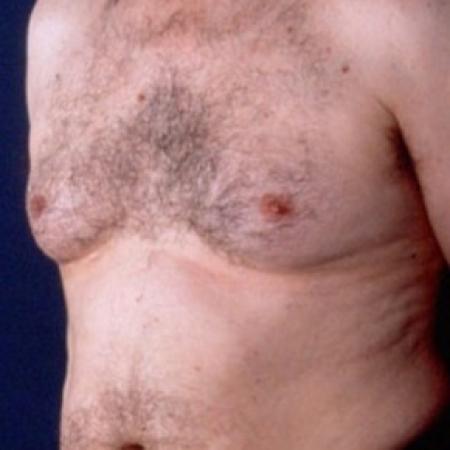 Before image 2 Case #81516 - Gynecomastia