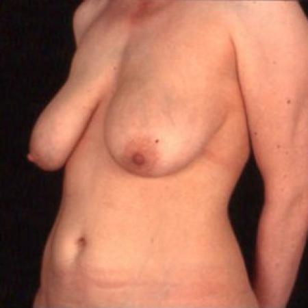 Before image 2 Case #81476 - Breast Lift