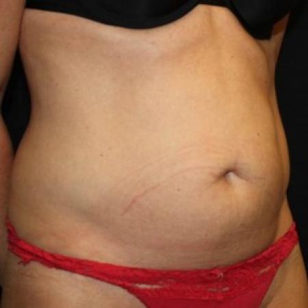Before image 2 Case #83726 - Abdominoplasty - 37 year old female.