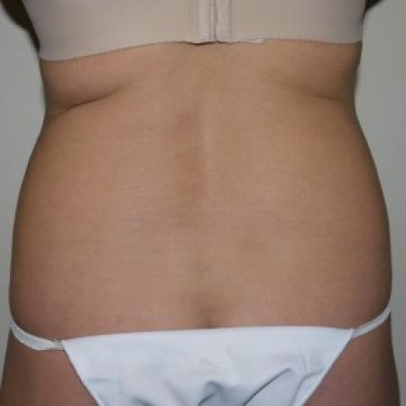 Before image 3 Case #82561 - Liposuction of the abdomen and hips