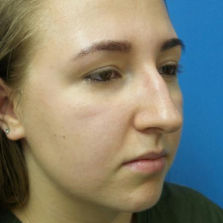Before image 2 Case #88316 - 19 year old  -  Open Rhinoplasty  -  6 months post-op
