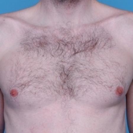 Before image 1 Case #79266 - Male Breast Reduction