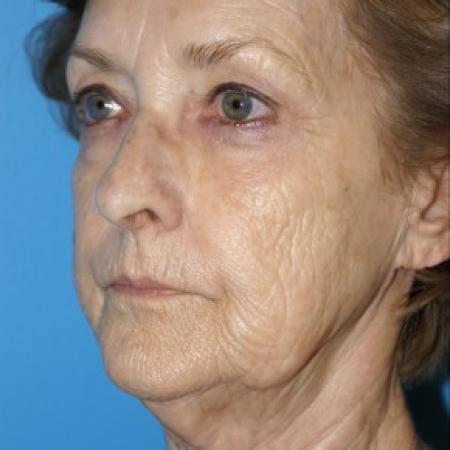 Before image 2 Case #86621 - Facelift/Liposuction of the Neck/Laser Resurfacing to Full Face     3 months post-op