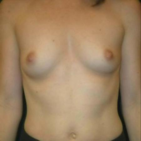 Before image 1 Case #82891 - Breast Augmentation using Smooth Round Silicone Gel Implants