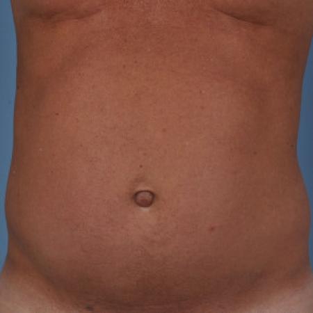 Before image 1 Case #88296 - Male abdomen and hiprolls