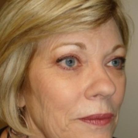 Before image 2 Case #79056 - Facelift