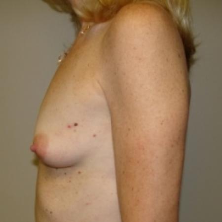 Before image 3 Case #79361 - Breast Augmentation 