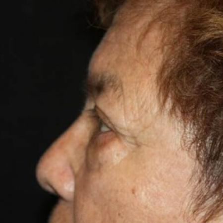 Before image 3 Case #84706 - Blepharoplasty and Brow Lift - 78 year old female.