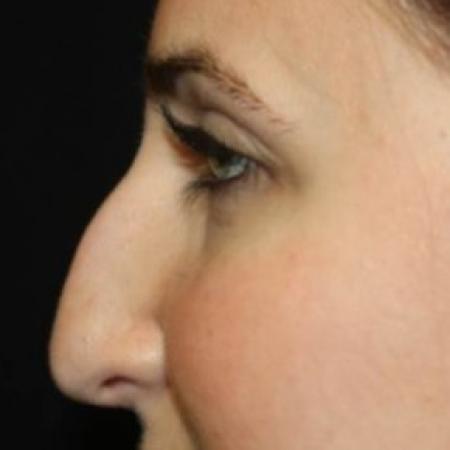 Before image 3 Case #83401 - Rhinoplasty  - 24 year old female.