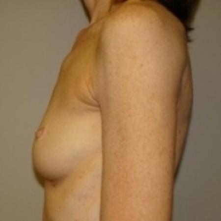 Before image 3 Case #79731 - Breast Augmentation