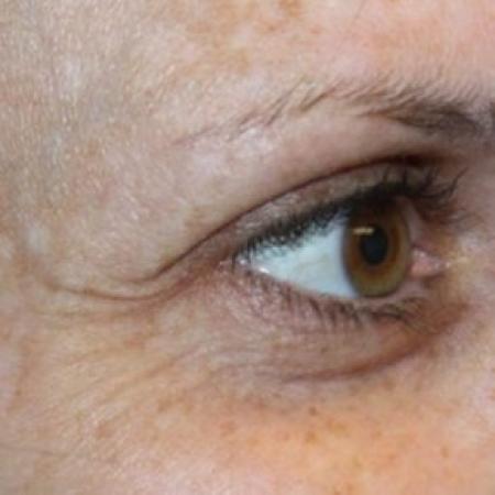 Before image 3 Case #83891 - Botox (Crows Feet Only) - 34 year old female.