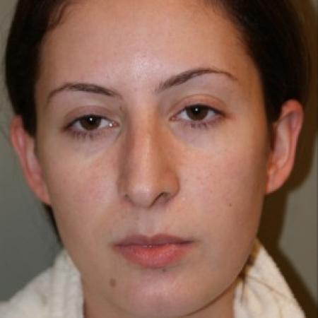 Before image 1 Case #81871 - Open Septorhinoplasty