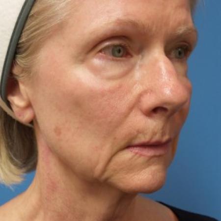 Before image 2 Case #86581 - Facelift/Upper Blepharoplasty     2 months post-op
