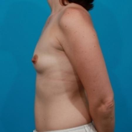 Before image 3 Case #78591 - Silicone Breast Implants