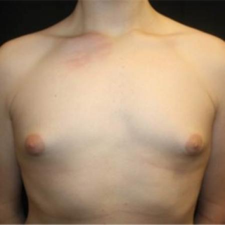 Before image 1 Case #84536 - Gynecomastia - 17 year old male