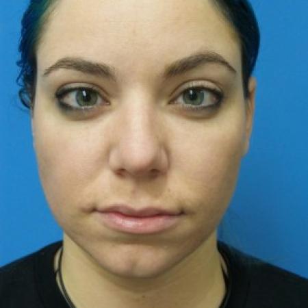 Before image 3 Case #86936 - 29 year old  -  Rhinoplasty/Chin Augmentation/Submental Liposuction to Neck  -  2 months post-op