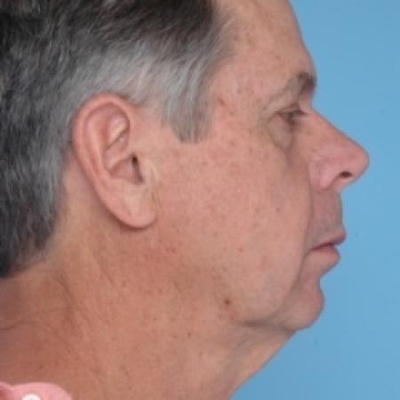 Before image 3 Case #79686 - Facelift
