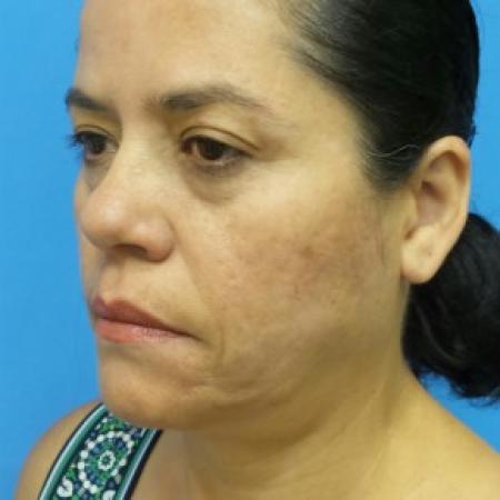 Before image 2 Case #87341 - 54-year old - Upper & Lower Blepharoplasty/Facelift/Fat Grafting  to  Upper Cheeks & Lower Lids/Skin Resurfacing to both cheeks   3 months post-op