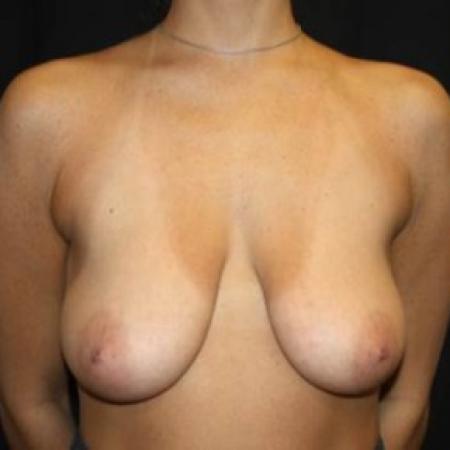 Before image 1 Case #85036 - Breast lift with breast implants - 28 year old female