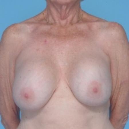 Before image 1 Case #79666 - Breast Augmentation 
