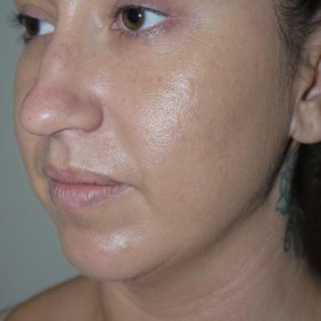 Before image 2 Case #82556 - Liposuction of the chin and neck