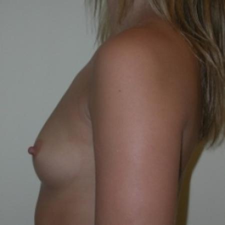Before image 3 Case #80666 - Breast Augmentation