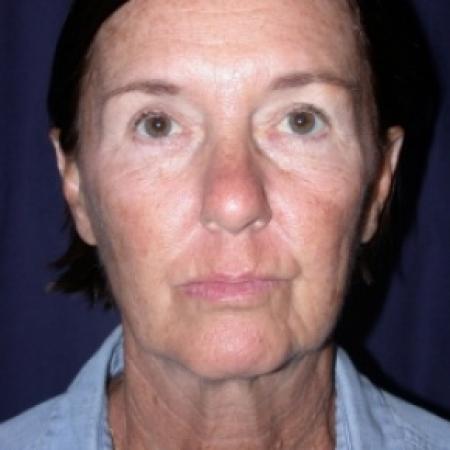 Before image 1 Case #78811 - FaceLift- Minimal Access Cranial Suspension (MACS)/ Fat Grafting 
