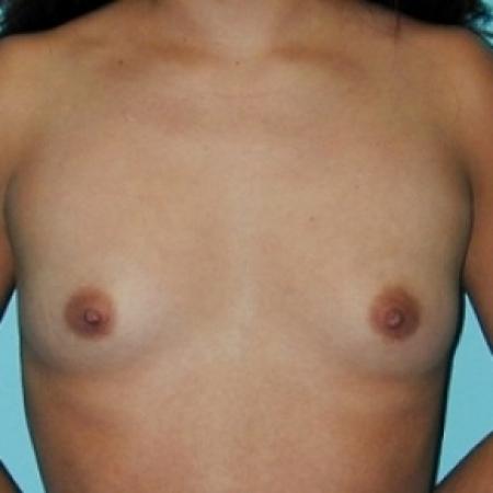 Before image 1 Case #79086 - Saline Breast Implants