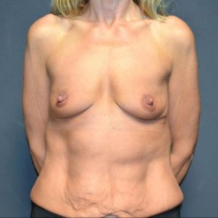 Before image 1 Case #83481 - 49 Years Old Female 