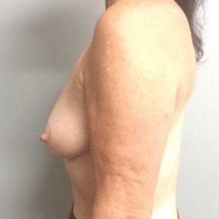 Before image 2 Case #88151 - Breast Reconstruction on a 68 year old female