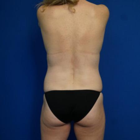 Before image 4 Case #88366 - 46 year old female after Mommy Makeover