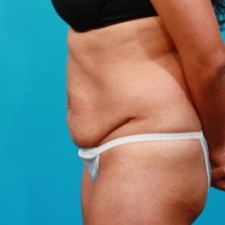 Before image 3 Case #78861 - Extended Abdominoplasty