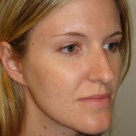 Before image 3 Case #79551 - Rhinoplasty