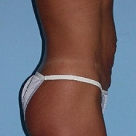Before image 2 Case #79146 - Tummy Tuck