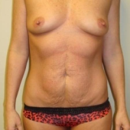 Before image 1 Case #79036 - Tummy Tuck