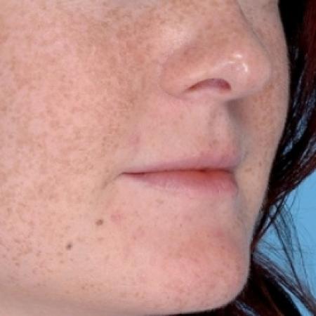 Before image 2 Case #79291 - Injectables