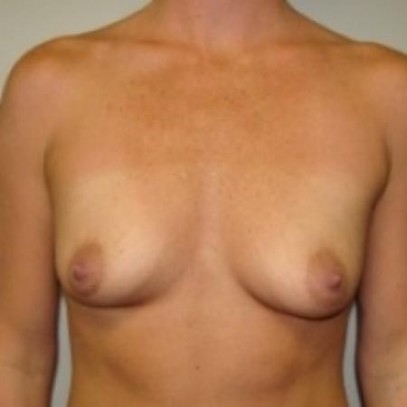 Before image 1 Case #79736 - Breast Augmentation