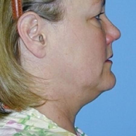 Before image 2 Case #79216 - Liposuction