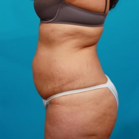 Before image 3 Case #85746 - Abdominoplasty with Flank Liposuction