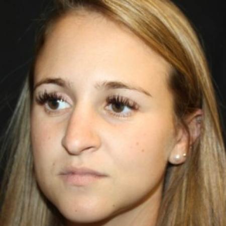 Before image 2 Case #84211 - Rhinoplasty - 24 year old female.