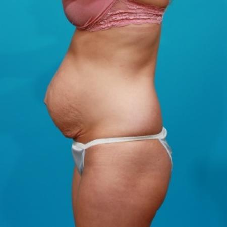 Before image 3 Case #78946 - Tummy Tuck & Flank Lipo