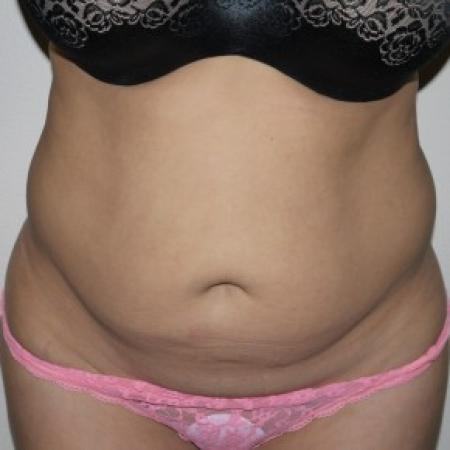 Before image 1 Case #82386 - Abdominoplasty