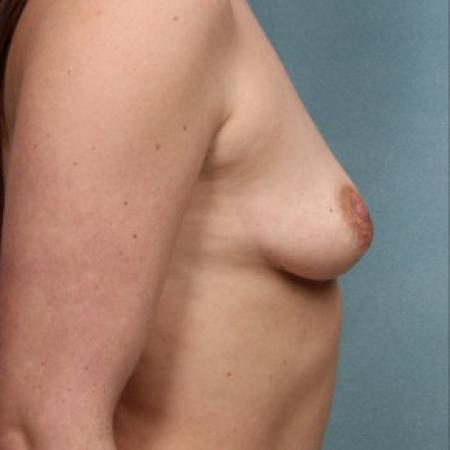 Before image 3 Case #86786 - Breast Augmentation 